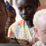 People With Albinism Face Discrimination, Danger