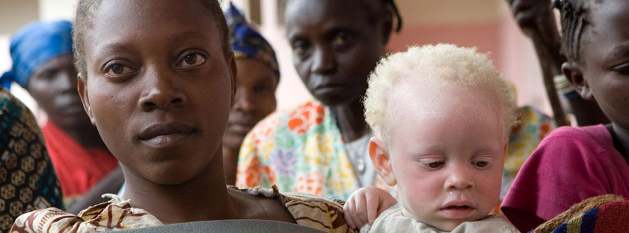People With Albinism Face Discrimination, Danger